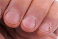 Damaged and bitten fingernails close-up