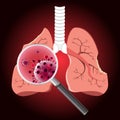 Damaged from Coronavirus cells with magnifying glass inspecting the affected on lung. 2019-nCoV concept