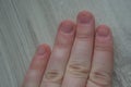 Damaged fingernails from biting due to anxiety disorders with damaged cuticles from skin picking. Dermatillomania distress and