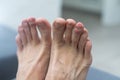 damaged a large nail on the male foot. Royalty Free Stock Photo