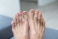 damaged a large nail on the male foot. Royalty Free Stock Photo