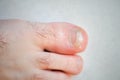 Damaged a large nail on the male foot Royalty Free Stock Photo