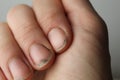 Damaged damaged nail without manicure with dirt close-up. Nail Health Care