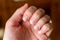 Damaged nails. Bitten fingernails on woman`s hand.