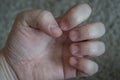 Damaged nails on hand from biting and dermatillomania/compulsive skin picking disorder long term. Torn cuticles. Conpects of