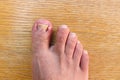 Damaged toenail. The thumb on the man`s leg. Royalty Free Stock Photo