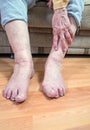 Damaged toes and wrinkled hand