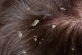 Dandruff in the hair. Flaky scalp. Royalty Free Stock Photo