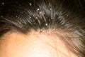 Dandruff on the hair. Hair disease seborrhea. Fatty Dandruff. Royalty Free Stock Photo