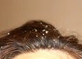 Dandruff on the hair. Hair disease seborrhea. Fatty Dandruff. Royalty Free Stock Photo