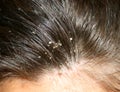 Dandruff on the hair. Hair disease seborrhea. Fatty Dandruff. Royalty Free Stock Photo