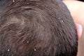 Dandruff in the hair Royalty Free Stock Photo