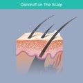 Dandruff on the scalp. Hair illustration.