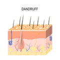Dandruff. seborrheic dermatitis