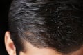 Dandruff visible in a tight frame of a mans hair strands