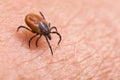 Infected female deer tick on hairy human skin. Ixodes ricinus. Parasitic mite. Acarus Royalty Free Stock Photo