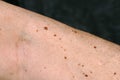 Dangerous or harmless pigment spots on the skin