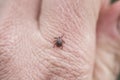 Dangerous infectious insect mite crawls on the skin of the human hand to suck the blood Royalty Free Stock Photo