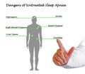 Dangers of Untreated Sleep Apnea Royalty Free Stock Photo