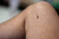 Dark brow birthmark or naevus on male leg Royalty Free Stock Photo