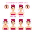 Dark Circles Under the Eyes. Beautiful Tired Woman. Treatment. Girl Washes her Face, Uses Eye Patches and Cucumbers. Before and