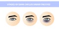 Dark circles under female eyes of different intensities, vector