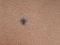 Dark colour Blue neuronevus mole aka dermal melanocytoma, a type of melanocytic nevus. Generally benign.