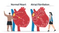 Data comparison of Normal heart and Atrial fibrillation. AF is common type of irregular heartbeat. Electrical signals in atrium