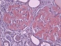 Histopathology of a Kidney with Amyloid deposits