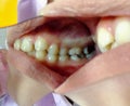 Decayed teeth check-up