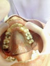 Decayed teeth check-up