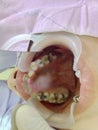 Decayed teeth check-up