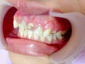 Decayed teeth check-up