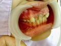 Decayed teeth check-up