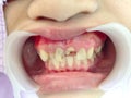 Decayed teeth check-up