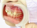 Decayed teeth check-up