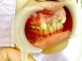 Decayed teeth check-up