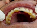 Decayed teeth check-up