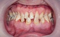 Decayed teeth