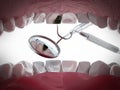 Decayed tooth diagnosis and treatment. 3D illustration