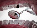 Decayed tooth diagnosis and treatment. 3D illustration