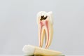 Decayed tooth model