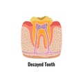 Decayed Tooth Poster