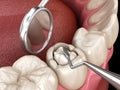 Decayed tooth restoration with composite filling. Medically accurate tooth 3D illustration