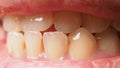 Decayed tooth root canal treatment. Tooth or teeth decay of lower molar
