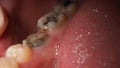 Decayed tooth root canal treatment. Tooth or teeth decay of lower molar