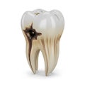 Decayed tooth showing cavity and root damage Royalty Free Stock Photo