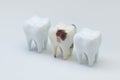 The decayed tooth beside with the white tooth, 3d rendering Royalty Free Stock Photo