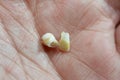 Deciduous primary baby temporary teeth, the first set of teeth in the growth and development of humans, They are usually lost and