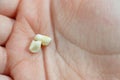 Deciduous primary baby temporary teeth, the first set of teeth in the growth and development of humans, They are usually lost and